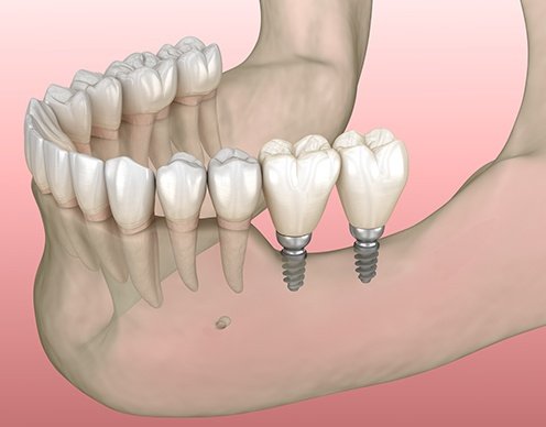 mini-dental-implants-1